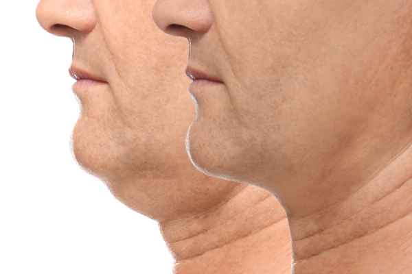 HIFU - Breakthrough in Anti - ageing 2 hifu results Wilmslow