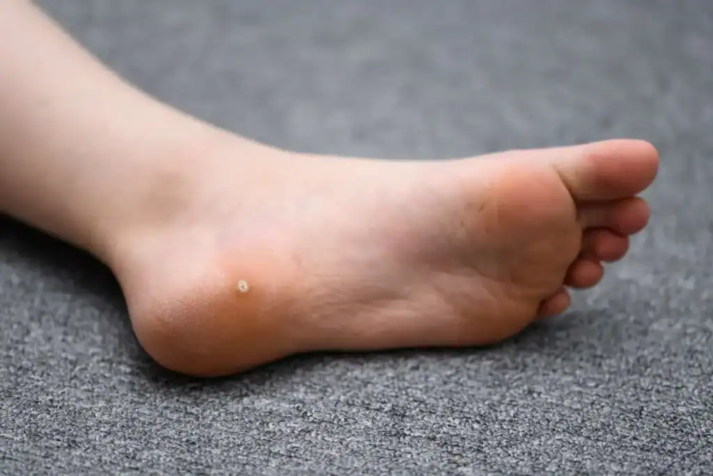 Cryotherapy For Warts And Also Verrucas 2 Image of verruca on the bottom of the foot that able to be treated with Cryotherapy Wilmslow