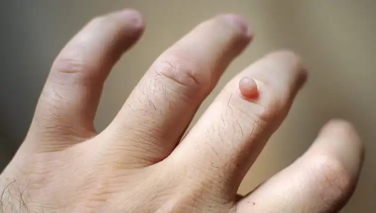 Cryotherapy For Warts And Also Verrucas 1 Image of blemish that Cryotherapy Wilmslow can remove with Lipo 360.
