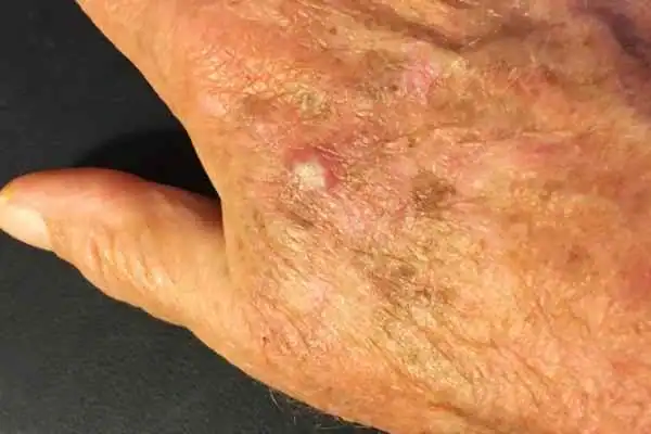 Image of Actinic keratoses Wilmslow on a person hand