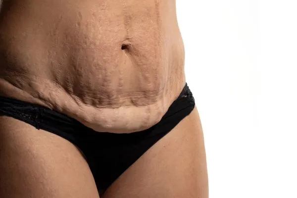 The Science of Skin Tightening 1 The science behind skin tightening Wilmslow picture of a woman's sagging skin on the stomach